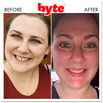 Byte Aligners 21 Before amp After Photos Pics of Real Results 