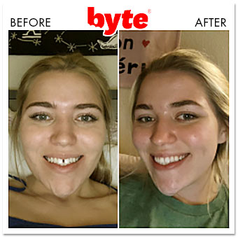byte before after emily