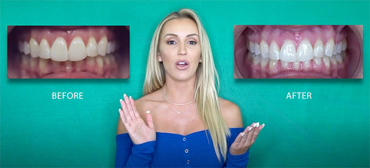 Byte Reviews Clear Teeth Aligners Do They Work 2021