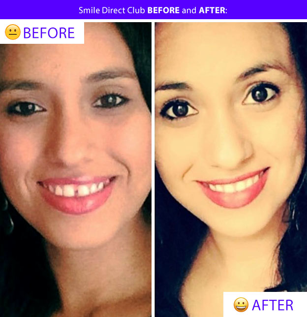 smile direct before after 5 months