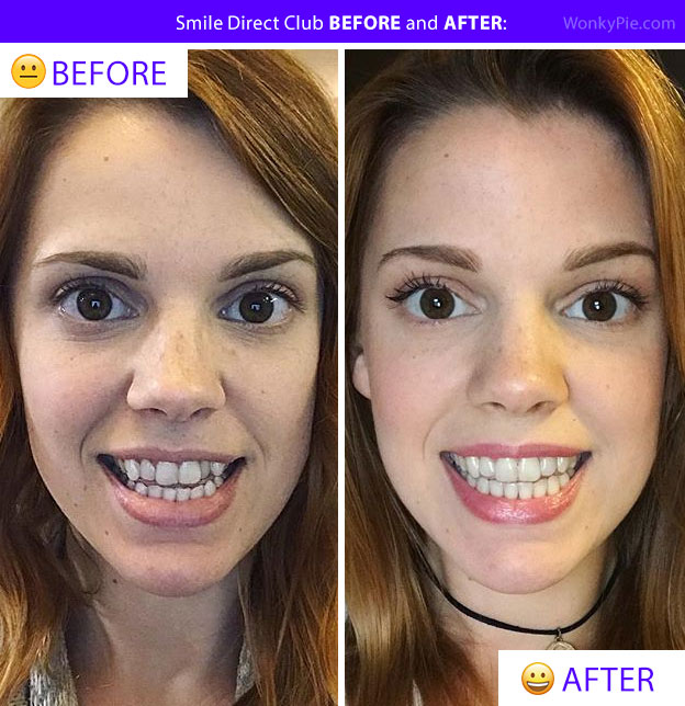Smile Direct Results: Overbite. 
