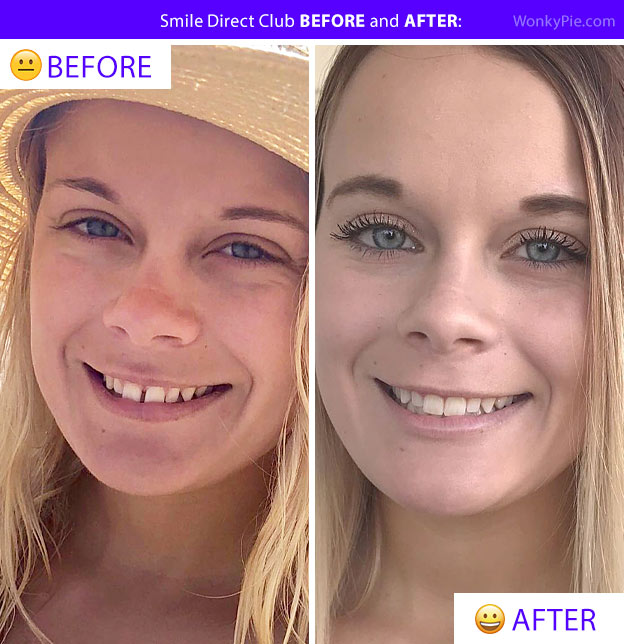 smile direct before after ashleigh