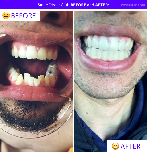 smile direct club before and after bryan teeth