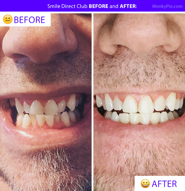 smile direct before after teeth caldred