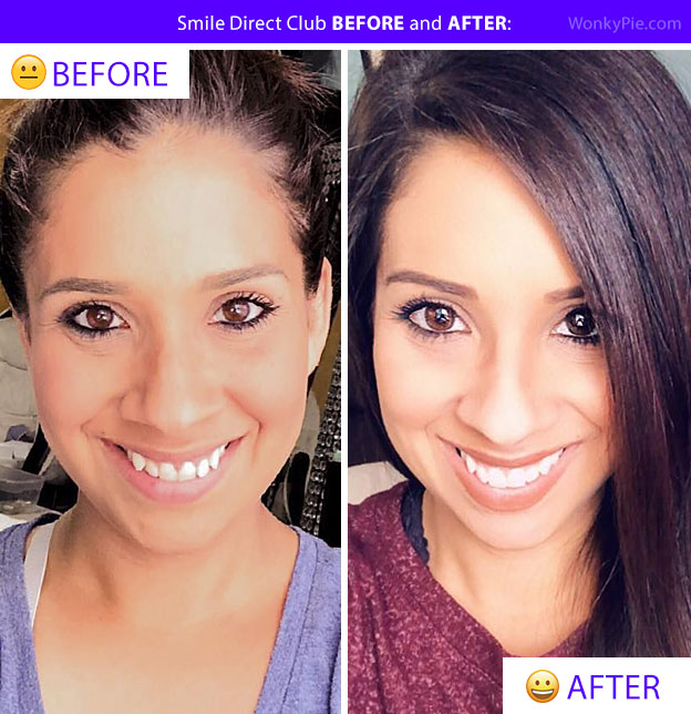 smile direct club before and after cara pic