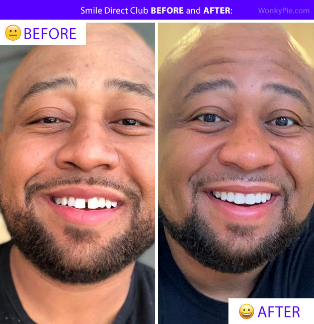 smile direct club before and after jaye photo