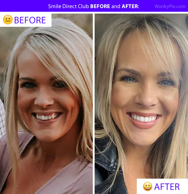 smile direct club before and after