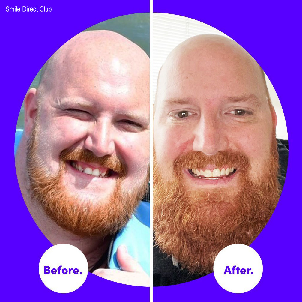 45 Smile Direct Club Before & After Photos, Transformation Pics!