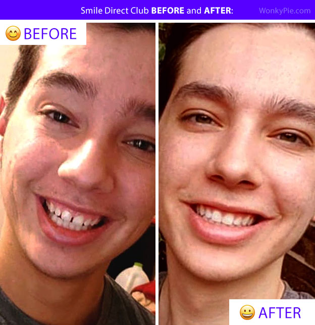 smile direct before after nate