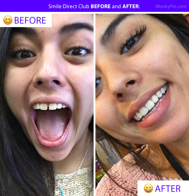 before and after smile direct club pic