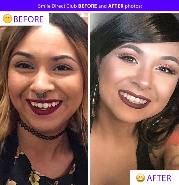 smile direct before after photos