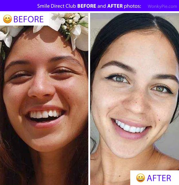 smile direct before after photos