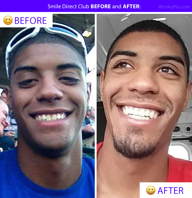 smile direct before after photos