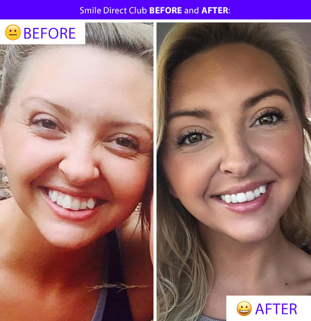 smile direct before after pic