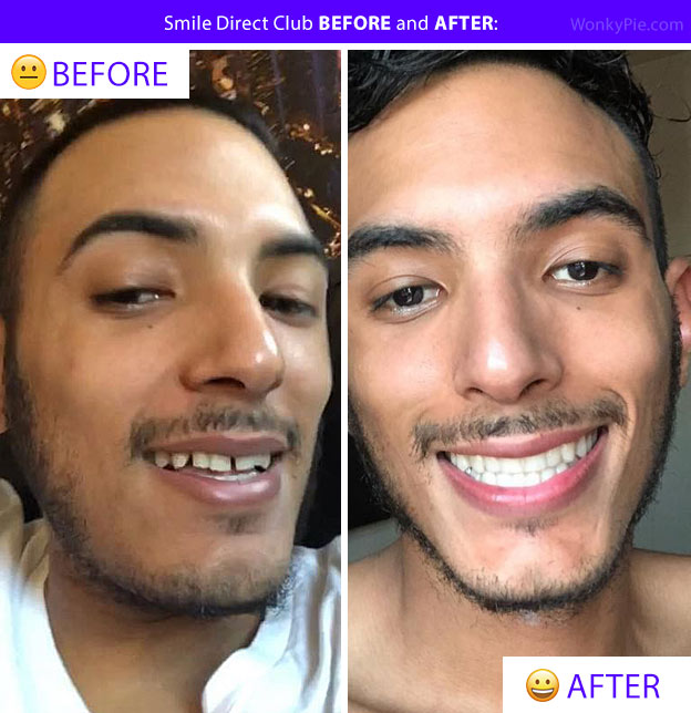 smile direct before after pics