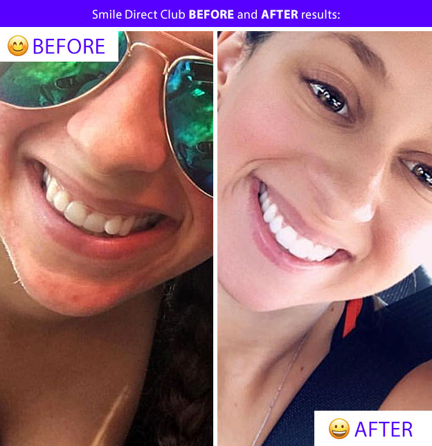 smile direct before after teeth