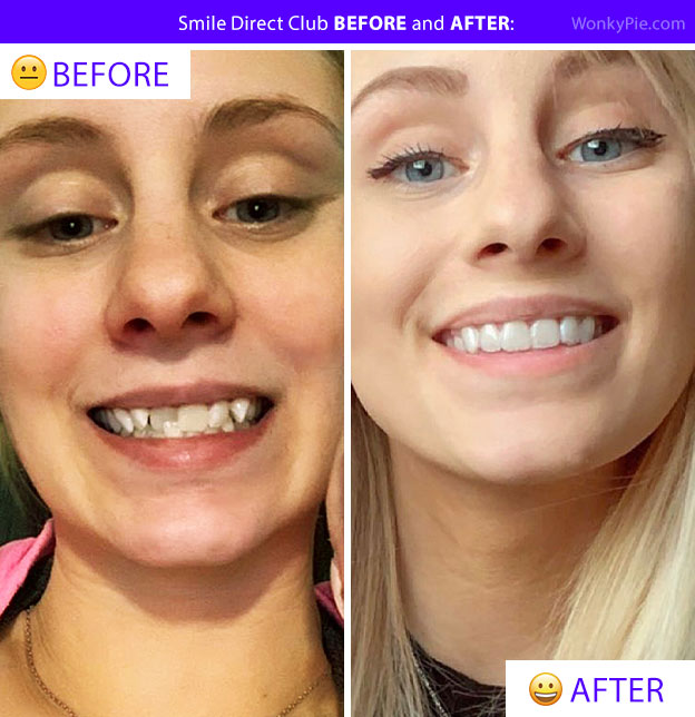smile direct before after pic tori